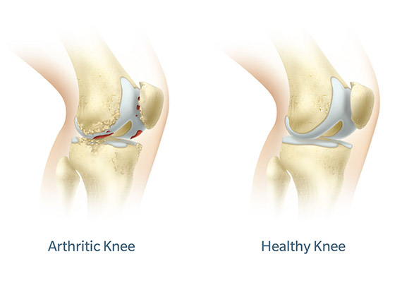 arthritic knee and healthy knee